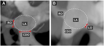 Evaluation of the pulmonary vein ostia during the cardiac cycle using electrocardiography-gated cardiac computed tomography in cats